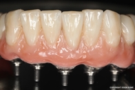 Impianto denti