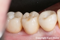 Ponte in zirconio