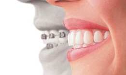 invisalign