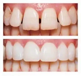 faccette dentali