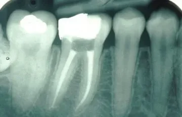 Endodonzia