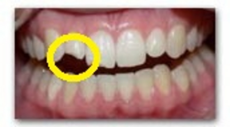 rottura del dente rottura del dente