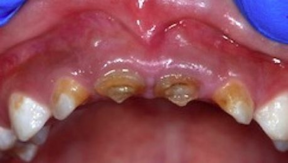 carie bambino carie bambino