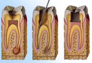 Terapia canalare Terapia canalare