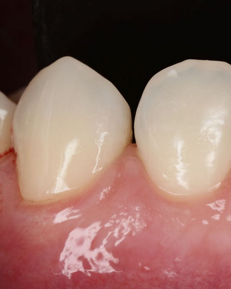 Copertura radicolare dopo Copertura radicolare dopo