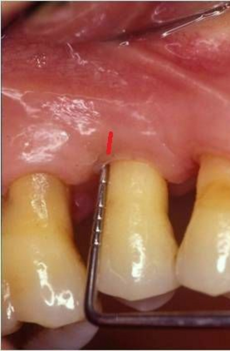 Parodonto restrittiva dopo Parodonto restrittiva dopo