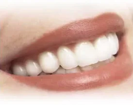 Sbiancamento denti