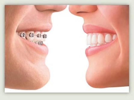 Invisalign per bambini Invisalign per bambini