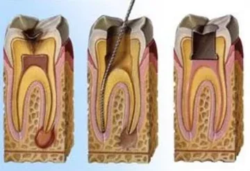 Terapia canalare