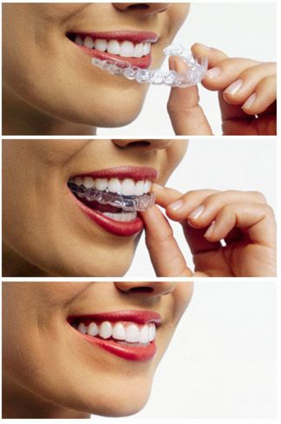 apparecchio invisibile apparecchio invisibile