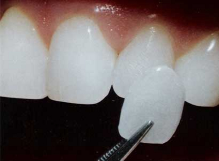 colore ideale per i tuoi denti faccette dentali