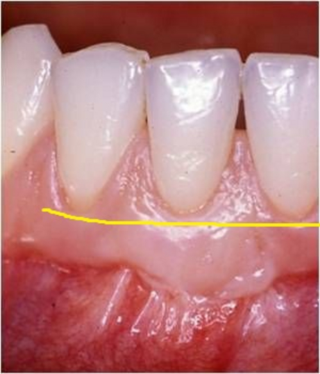 Copertura radicolare dopo Copertura radicolare dopo