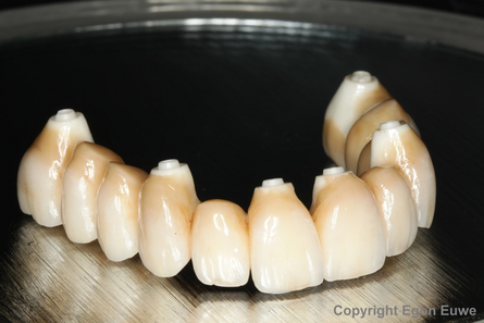 Protesi totale fissa in zirconio Protesi totale fissa in zirconio