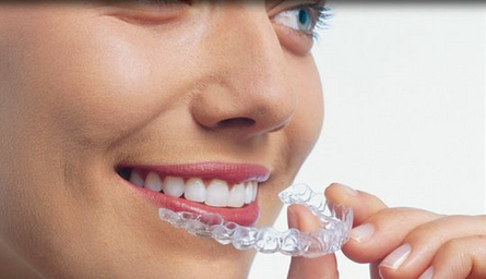 Invisalign invisalign
