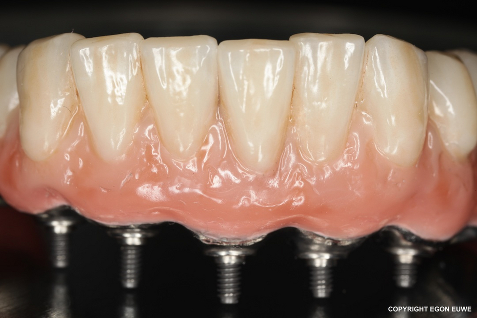 Impianto denti