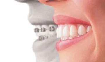 Invisalign a Novara