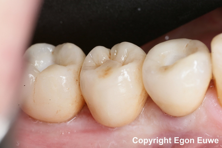 ponte in zirconio Ponte in zirconio