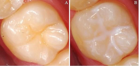 Sigillatura dei solchi Sigillatura dei solchi