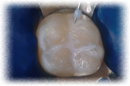 sigillatura dei solchi sigillatura dei solchi