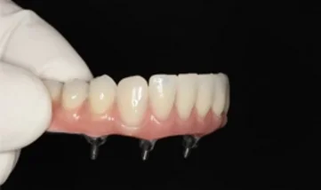 Implantologia - Studio dentistico a Novara