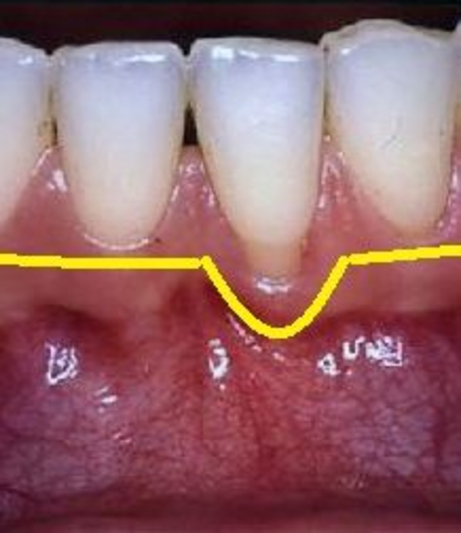 Copertura radicolare prima Copertura radicolare prima