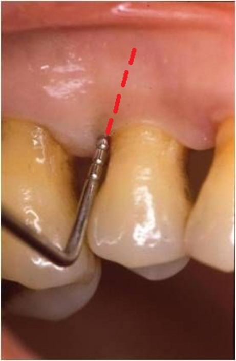 Parodonto restrittiva prima Parodonto restrittiva prima